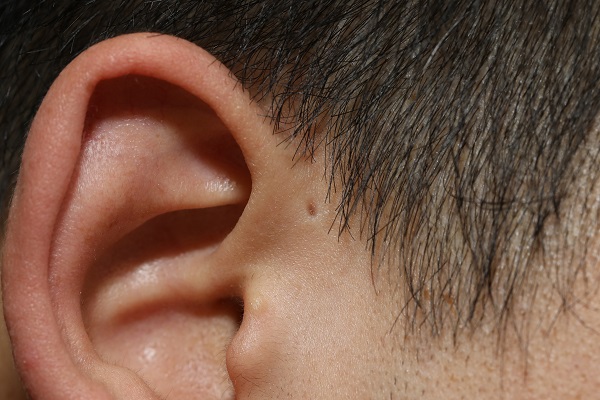ภัยเงียบกับโรค Ear pit รูเล็กๆ ข้างหู ในเด็ก