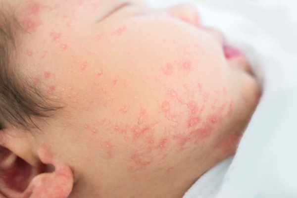 877 children rash allergic