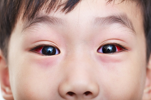 879 Disease hits Conjunctivitis in school